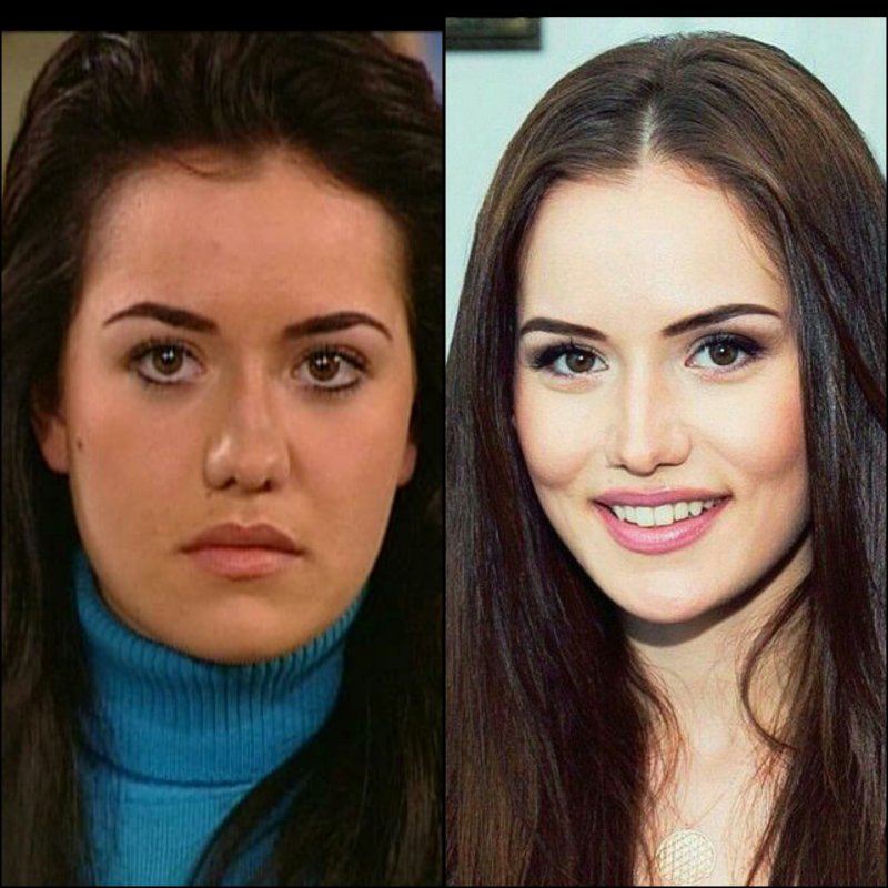 Фахрие эвджен до и после пластики